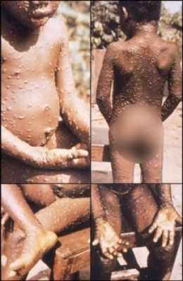 Monkeypox